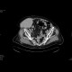 Large hematoma of the abdominal wall: CT - Computed tomography
